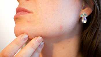 Laser Acne Treatment