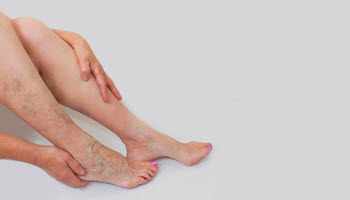 Laser Vein Therapy