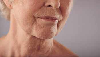 Juvederm Fillers