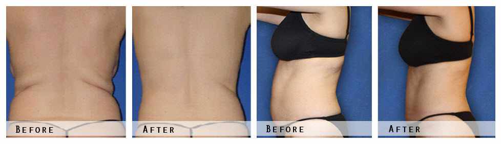 Laser Body Slimming Before & After