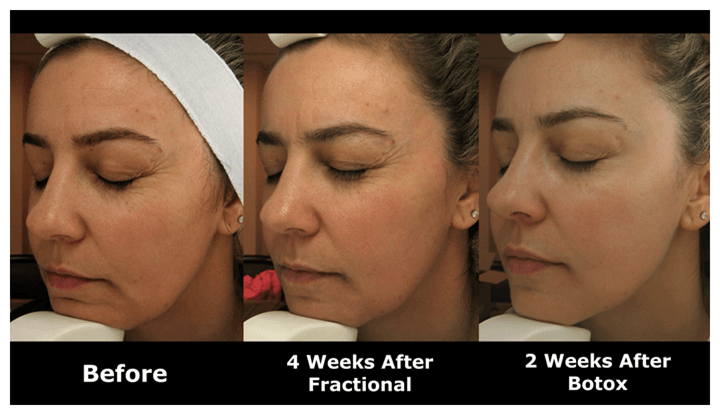 Laser Skin Resurfacing Before & After