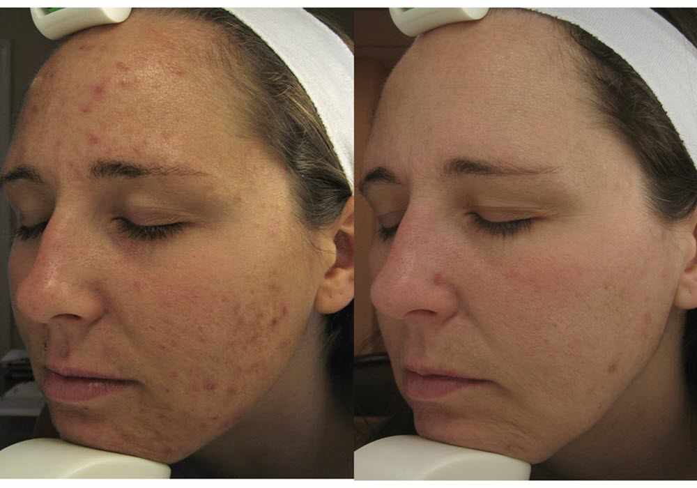 Laser Acne Treatment Before & After
