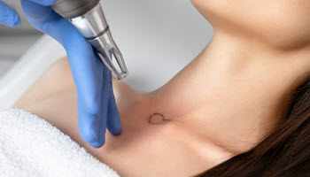 Laser Tattoo Removal